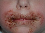 A study published today has found that a mysterious, itchy rash affecting children may be caused by a chemical in moist wipes