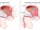 Nonsurgical treatment turns back the clock, shrinks enlarged  prostate