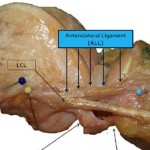 An image of a right knee after a full dissection of the anterolateral ligament (ALL). 